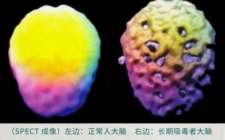为什么很多吸毒的人,裤子只拉到一半?