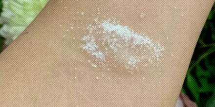 受伤后,为啥要在伤口上撒把白糖?