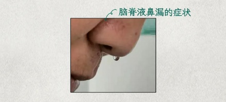 为什么尝到鼻涕变得甜甜的必须马上去医院？