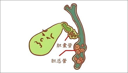 不吃早饭的人更容易得胆结石?