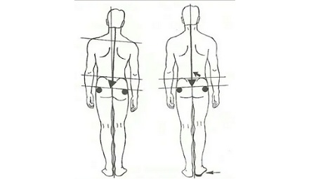 为什么招飞行员体检时,「屁股不对称」的人可能被刷?