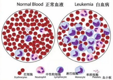 为什么脐带血可以治疗白血病?