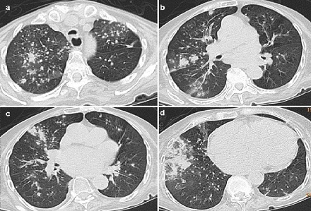 长时间闻霉味儿,肺里会长「毛」吗?