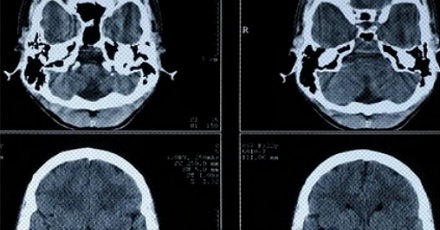 为什么拍了片子还要做 CT，做了 CT 又要上核磁共振？