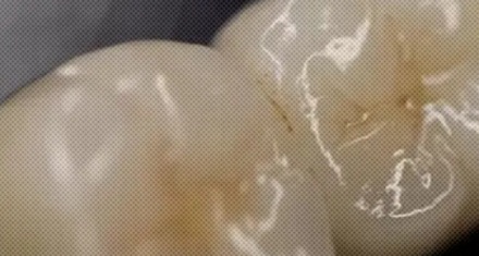 牙齿是最硬的器官，为啥遗体火化后只剩骨头，没有牙齿？