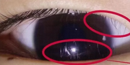 为什么眼上得了这种病，医生会建议你割个双眼皮？