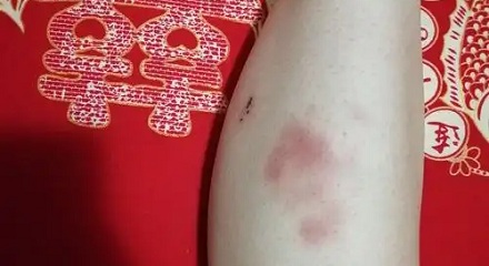 身上的淤青变成黄色，是快痊愈了还是更严重了？