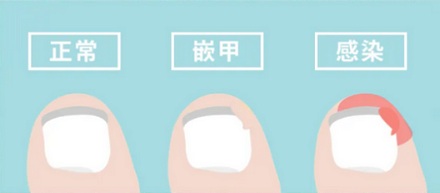 为什么千万不要把指甲剪成圆弧形？